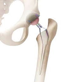 artificial joint-2.jpg